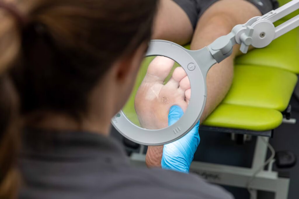 Verruca Treatment Tamworth